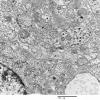 3H2 Neurocytoma, central (Case 3) EM 4 - Copy