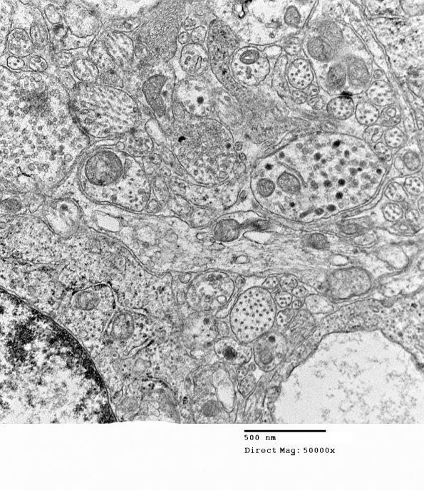 3H2 Neurocytoma, central (Case 3) EM 4 - Copy