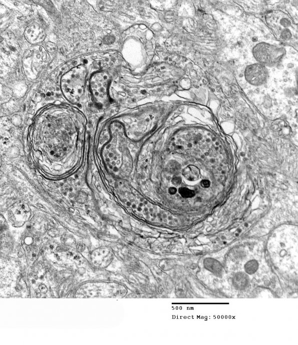 3H3 Neurocytoma, central (Case 3) EM 7 - Copy