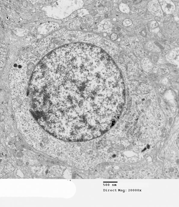 3H5 Neurocytoma, central (Case 3) EM 39 - Copy