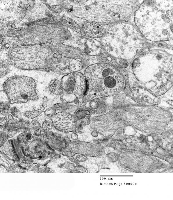 3H7 Neurocytoma, central (Case 3) EM 13 - Copy