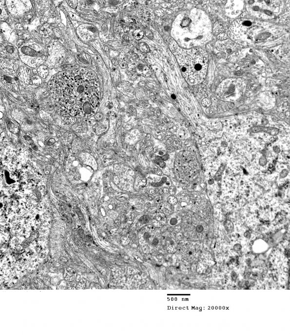 3H8 Neurocytoma, central (Case 3) EM 8 - Copy