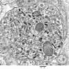 3H9 Neurocytoma, central (Case 3) EM 10 - Copy