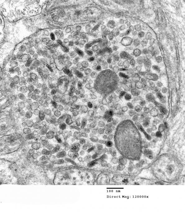 3H9 Neurocytoma, central (Case 3) EM 10 - Copy