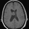 4A1 Neurocytoma, central, atypical (Case 4) T1 1 - Copy