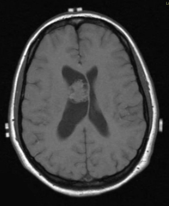 4A1 Neurocytoma, central, atypical (Case 4) T1 1 - Copy