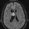 4A2 Neurocytoma, central, atypical (Case 4) T1 W2 - Copy