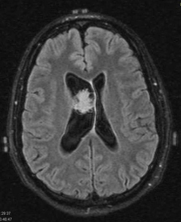 4A2 Neurocytoma, central, atypical (Case 4) T1 W2 - Copy