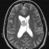 4A3 Neurocytoma, central, atypical (Case 4) T2 2 - Copy