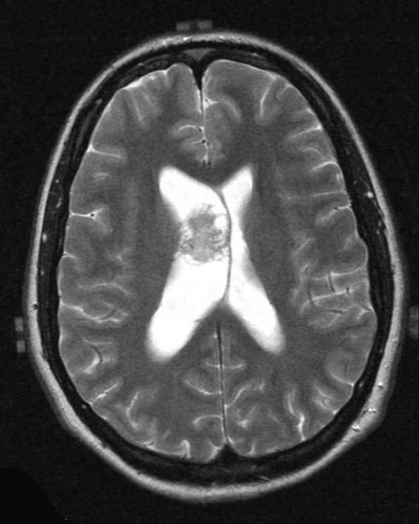 4A3 Neurocytoma, central, atypical (Case 4) T2 2 - Copy