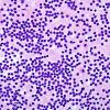 4B1 Neurocytoma, central, atypical (Case 4) H&E Smear 1