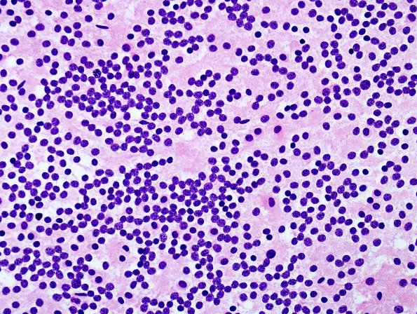 4B1 Neurocytoma, central, atypical (Case 4) H&E Smear 1