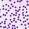 4B3 Neurocytoma, central, atypical (Case 4) H&E Smear 6 100X