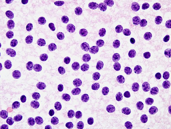 4B3 Neurocytoma, central, atypical (Case 4) H&E Smear 6 100X