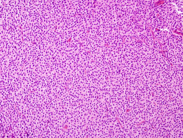 4B4 Neurocytoma, central, atypical (Case 4) H&E 4