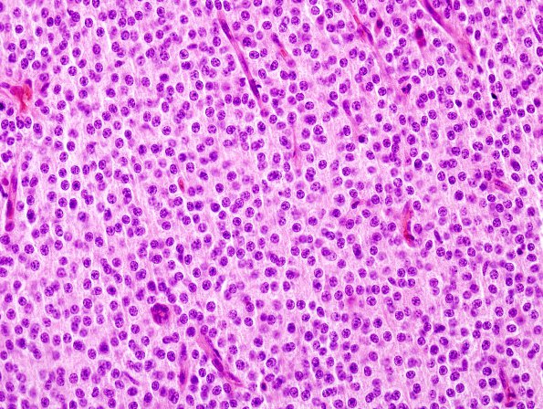 4B5 Neurocytoma, central, atypical (Case 4) H&E 3