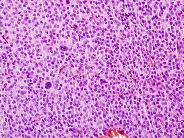 4B6 Neurocytoma, central, atypical (Case 4) H&E 1