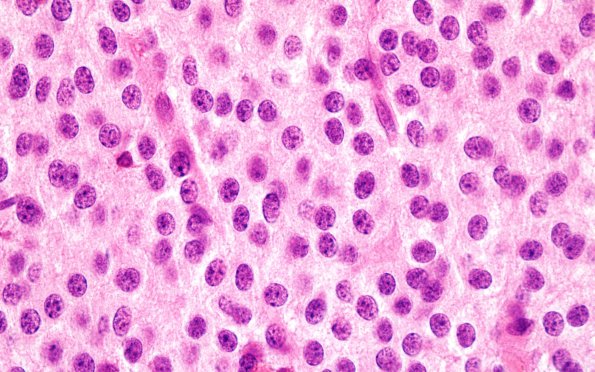 4B7 Neurocytoma, central, atypical (Case 4) H&E 100X 2
