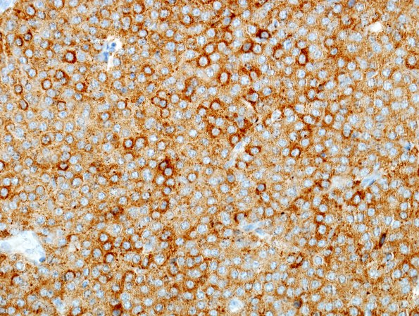 4C1 Neurocytoma, central, atypical (Case 4) SYN 5