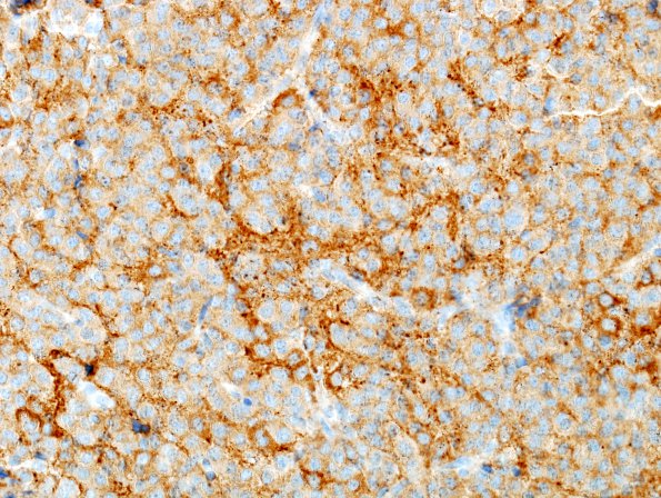 4C2 Neurocytoma, central, atypical (Case 4) SYN 4