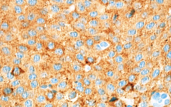 4C3 Neurocytoma, central, atypical (Case 4) SYN 100X 2