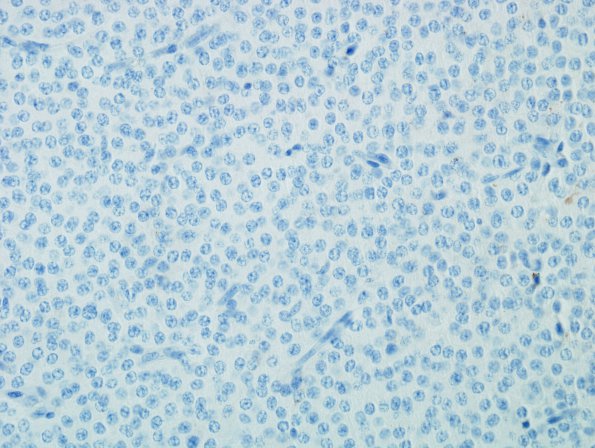 4D Neurocytoma, central, atypical (Case 4) Chrom 1