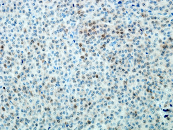 4E1 Neurocytoma, central, atypical (Case 4) NeuN 1