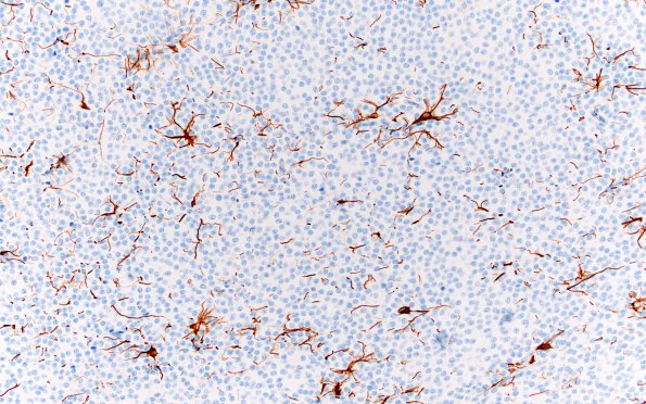 4F1 Neurocytoma, central, atypical (Case 4) GFAP 20X 2