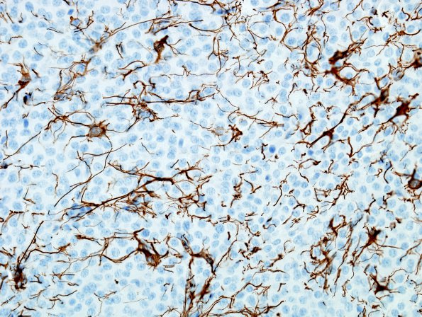 4F2 Neurocytoma, central, atypical (Case 4) GFAP 4