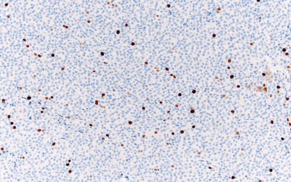 4G Neurocytoma, central, atypical (Case 4) Ki67 20X 2