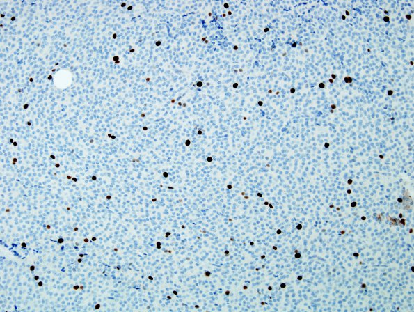 4G Neurocytoma, central, atypical (Case 4) MIB 2