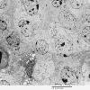 4J1 Neurocytoma, central, atypical (Case 4) EM 001 - Copy