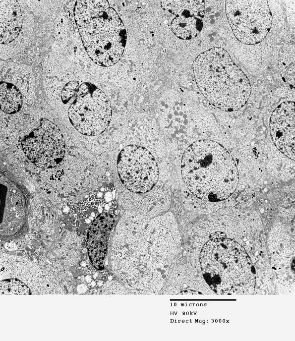 4J1 Neurocytoma, central, atypical (Case 4) EM 001 - Copy