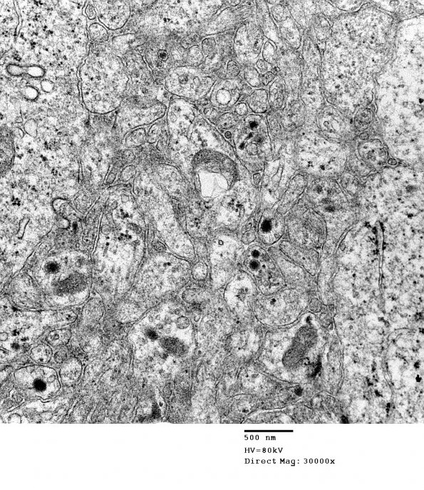 4J10 Neurocytoma, central, atypical (Case 4) EM 028 - Copy