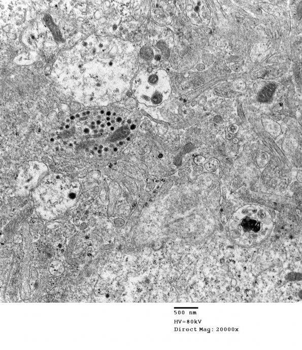 4J11 Neurocytoma, central, atypical (Case 4) EM 012 - Copy