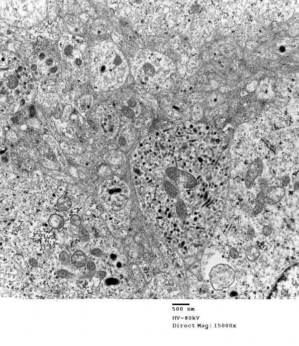 4J12 Neurocytoma, central, atypical (Case 4) EM 007 - Copy