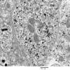 4J13 Neurocytoma, central, atypical (Case 4) EM 008 - Copy