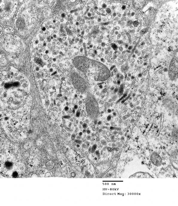 4J13 Neurocytoma, central, atypical (Case 4) EM 008 - Copy