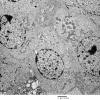 4J2 Neurocytoma, central, atypical (Case 4) EM 002 - Copy