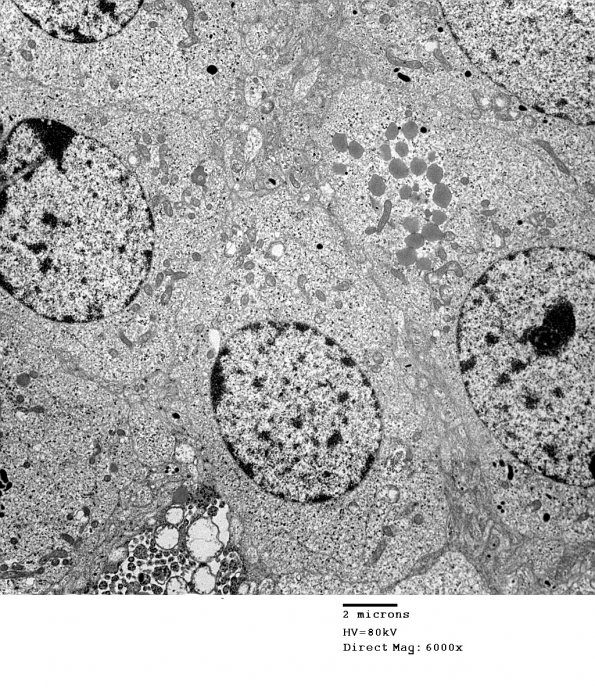 4J2 Neurocytoma, central, atypical (Case 4) EM 002 - Copy