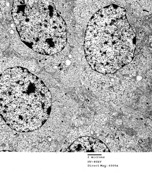 4J3 Neurocytoma, central, atypical (Case 4) EM 020 - Copy