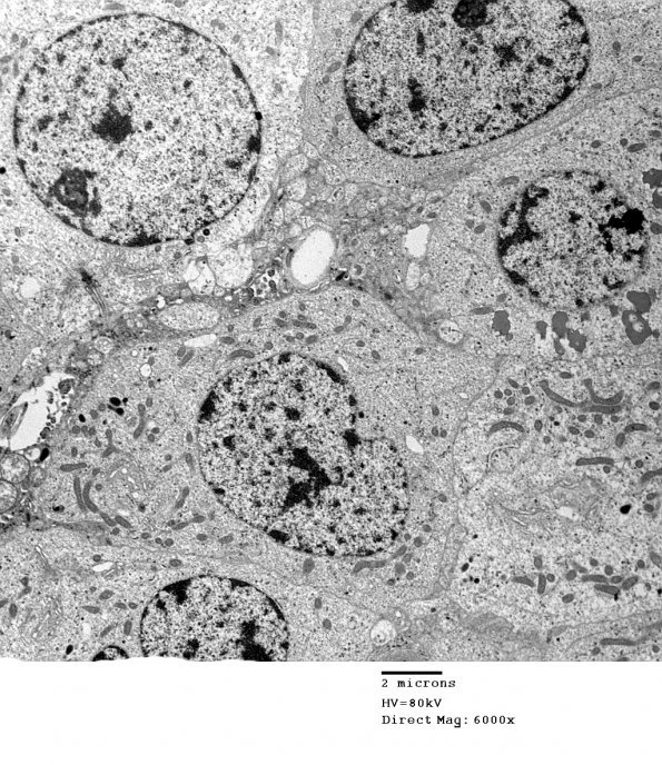 4J4 Neurocytoma, central, atypical (Case 4) EM 014 - Copy