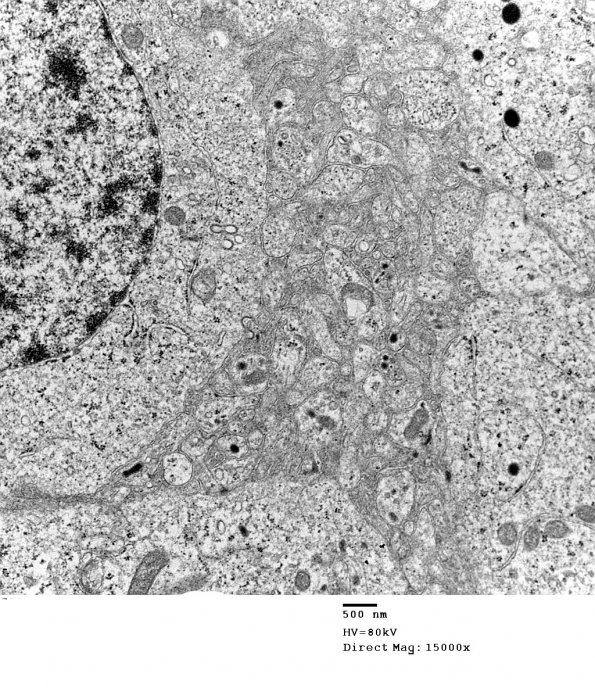 4J5 Neurocytoma, central, atypical (Case 4) EM 003 - Copy