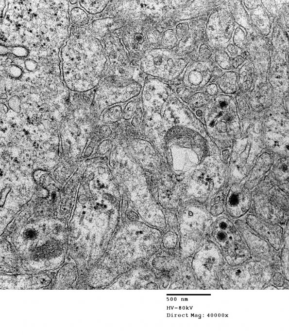 4J6 Neurocytoma, central, atypical (Case 4) EM 005 - Copy