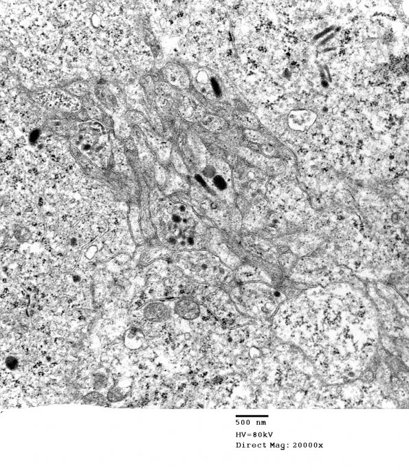 4J7 Neurocytoma, central, atypical (Case 4) EM 021 - Copy