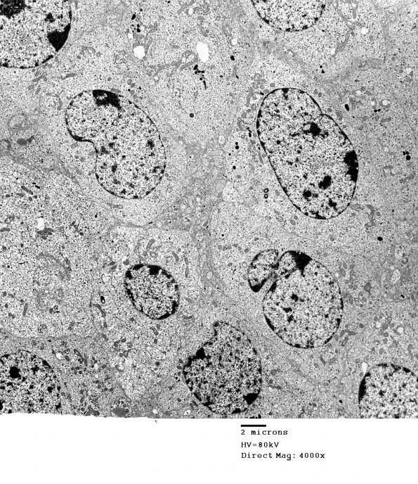 4J8 Neurocytoma, central, atypical (Case 4) EM 025 - Copy