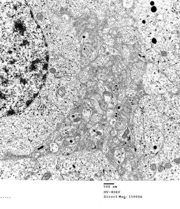 4J9 Neurocytoma, central, atypical (Case 4) EM 027 - Copy