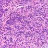 5A1 Central neurocytoma, atypical (Case 5) H&E 20X 1