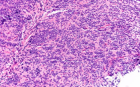 5A1 Central neurocytoma, atypical (Case 5) H&E 20X 1