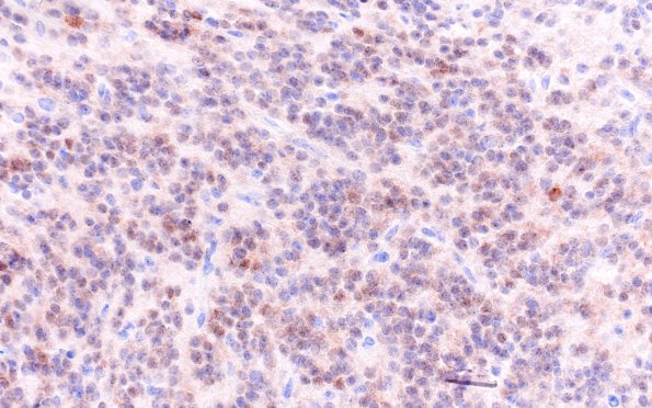 5B2 Central neurocytoma, atypical (Case 5) NeuN 40X